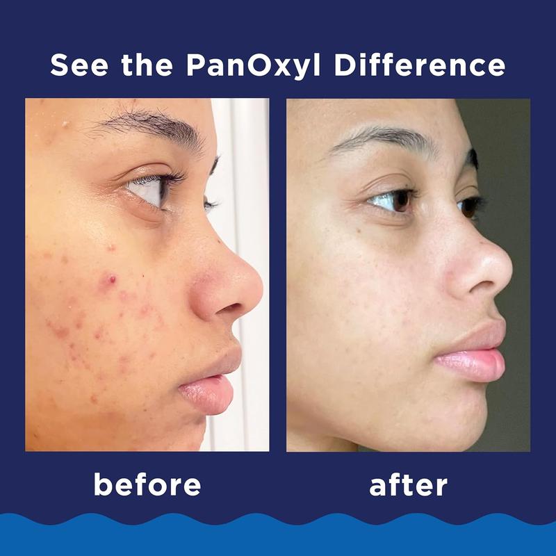 Panoxyl Acne Foaming Wash Benzoyl Peroxide 10% Maximum Strength Antimicrobial, 5.5 Oz Panoxyl