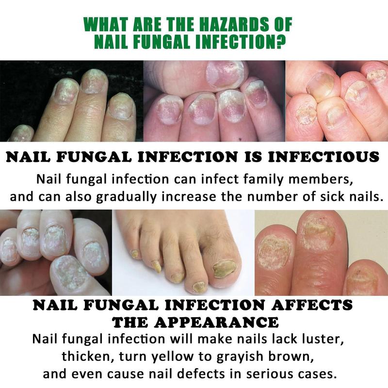 Ginger Nail oil Treatment Multi-Purpose Repair Solution for Discolored and Damaged Nail Care Comfort