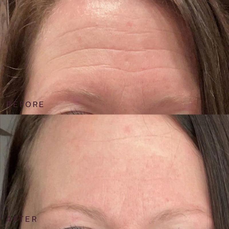 SILICONEFUSION™ Forehead Patches