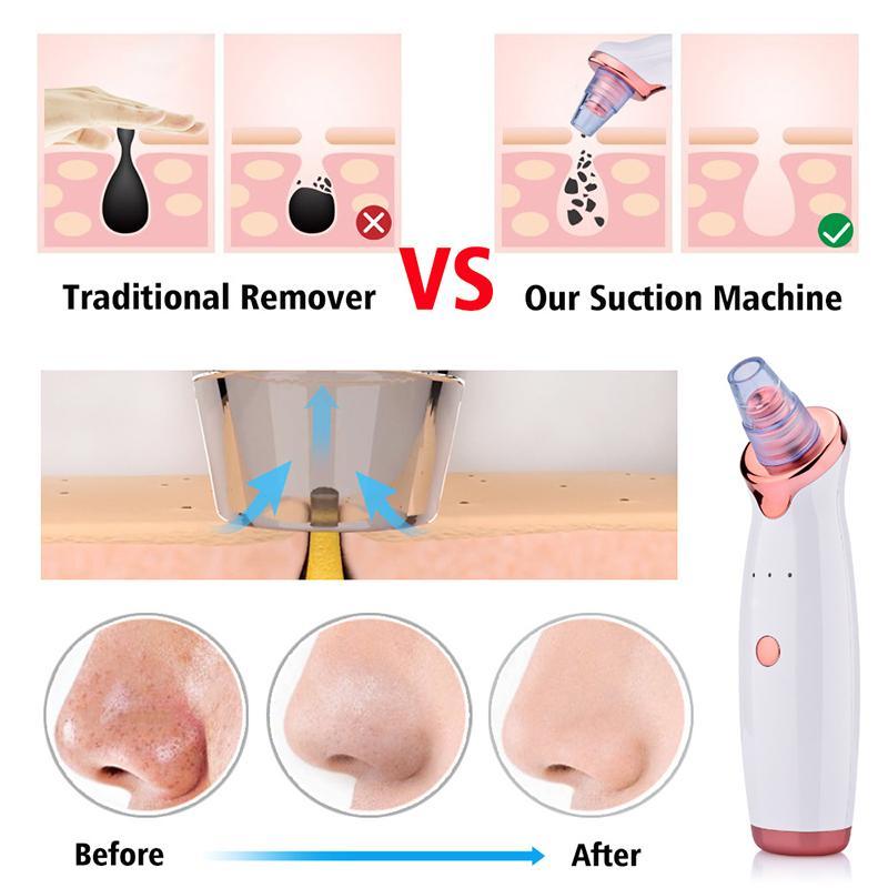 Multi-function Blackhead Remover, 1 Count Acne Removal Suction Tool, Professional Skin Care Tools for Women