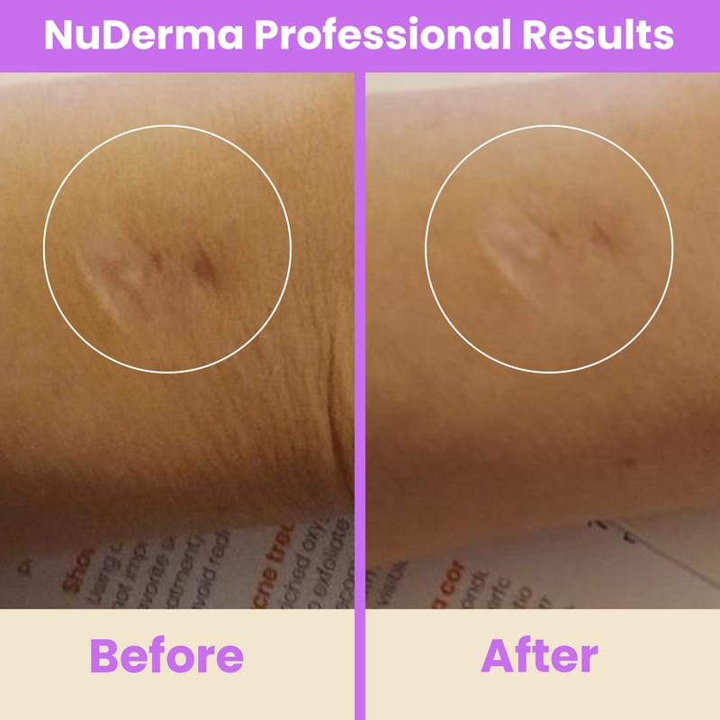 NuDerma Professional High Frequency Wand by Pure Daily Care with Argon & Neon Applicators Anti-Aging and Anti-Acne