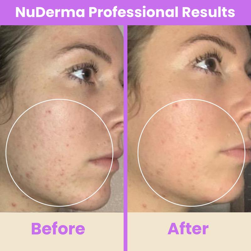 NuDerma Professional High Frequency Wand by Pure Daily Care with Argon & Neon Applicators Anti-Aging and Anti-Acne