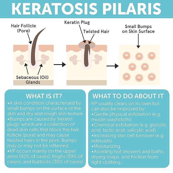 Rida Hair Research Institute Keratosis Pilaris Lotion with Glycolic Acid, AHA & BHA Exfoliating | Strawberry Legs, KP & Ingrown Hair Treatment | Bumpy Skin Body Lotion | Moisturizing Cream for Redness, Dry, Rough & Flakey Skin